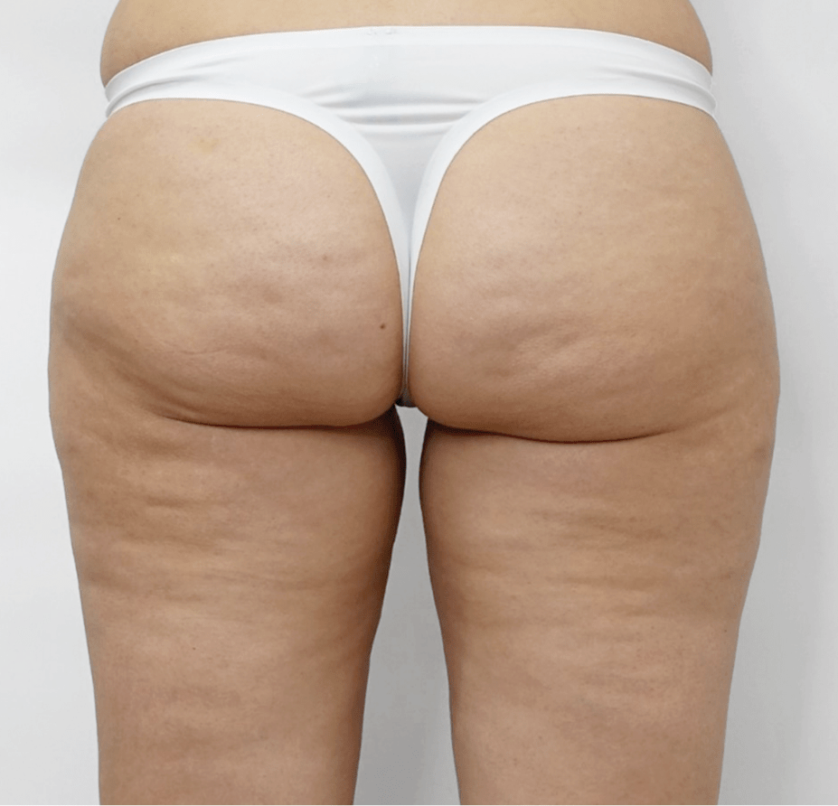 Before Endermologie cellulite treatment