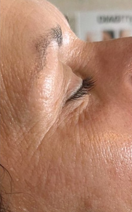After Endermologie facial treatment
