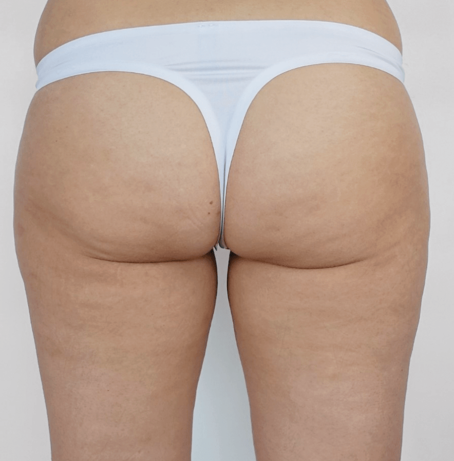 After Endermologie cellulite treatment