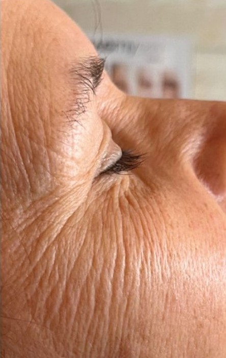 Before Endermologie facial treatment