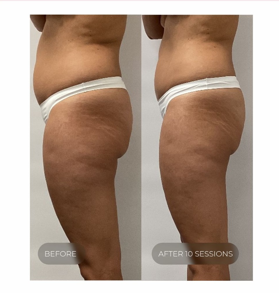 Thighs and buttocks before and after ten LPG sessions