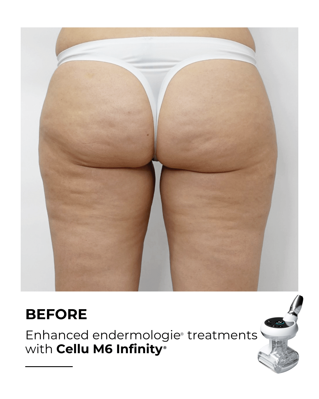 Cellulite on the thighs before LPG treatment