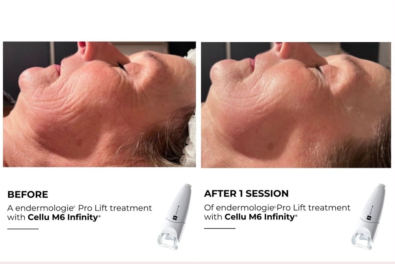Jawline after one LPG facial session