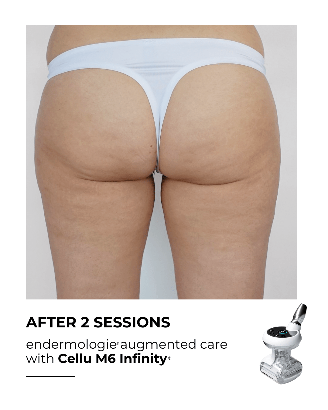 Cellulite on the thighs after two LPG sessions