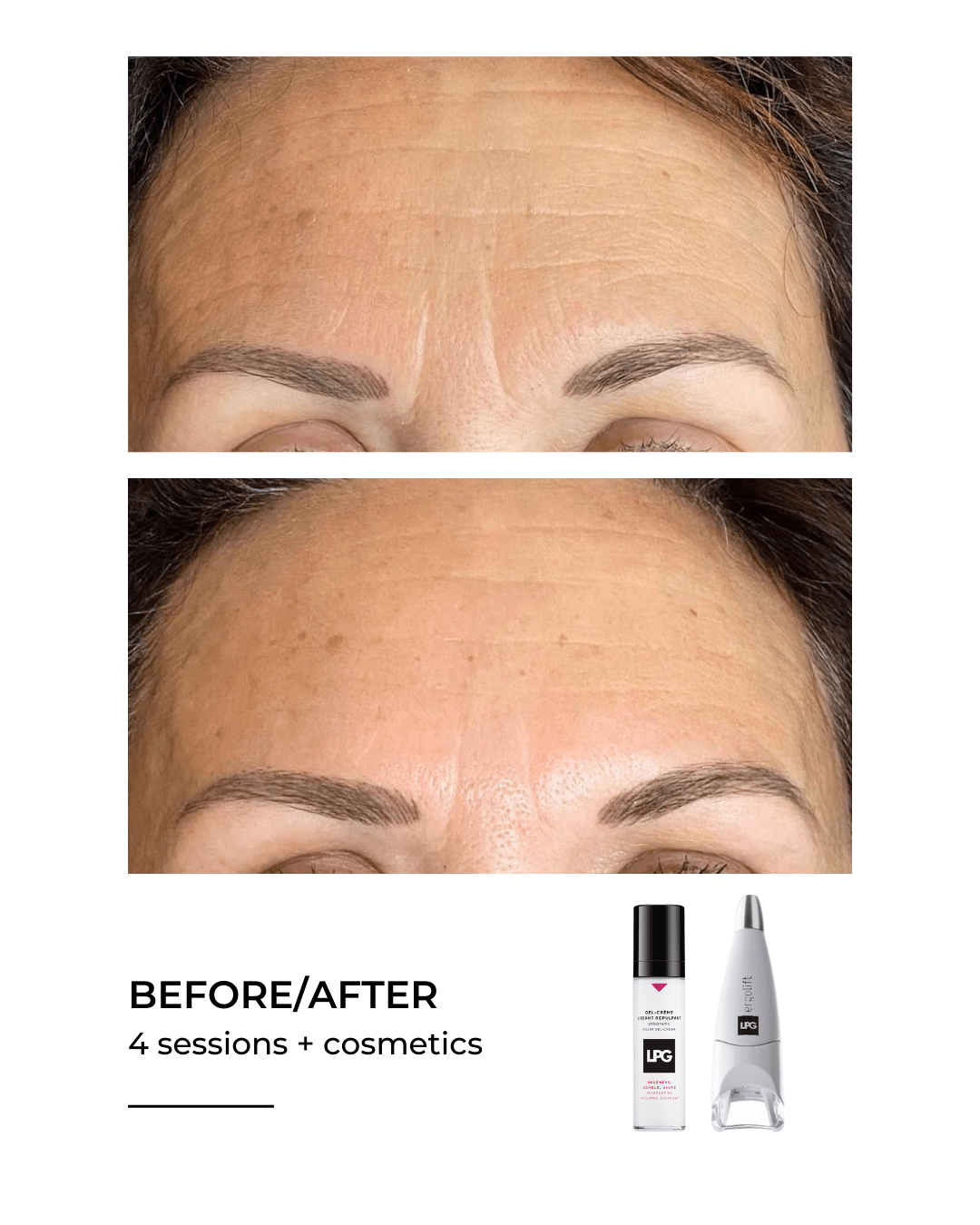 Forehead lines before and after four LPG sessions
