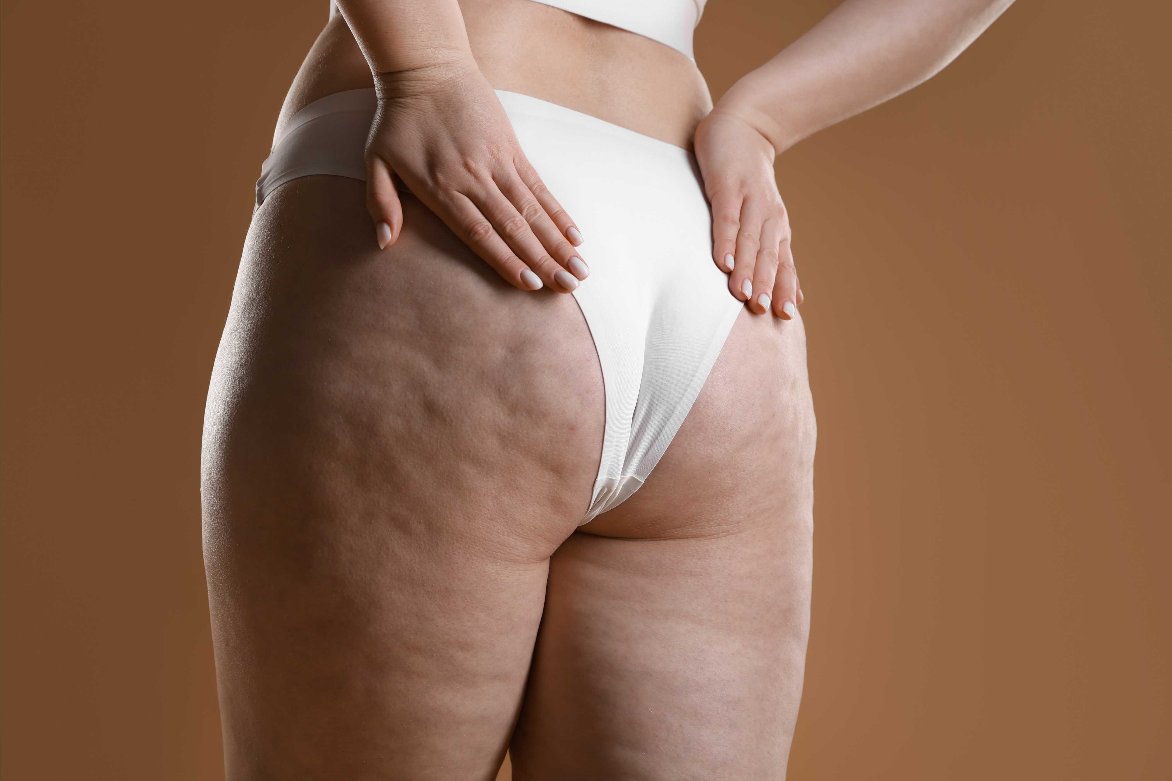 Does LPG Endermologie Really Work for Cellulite? What the Research Says