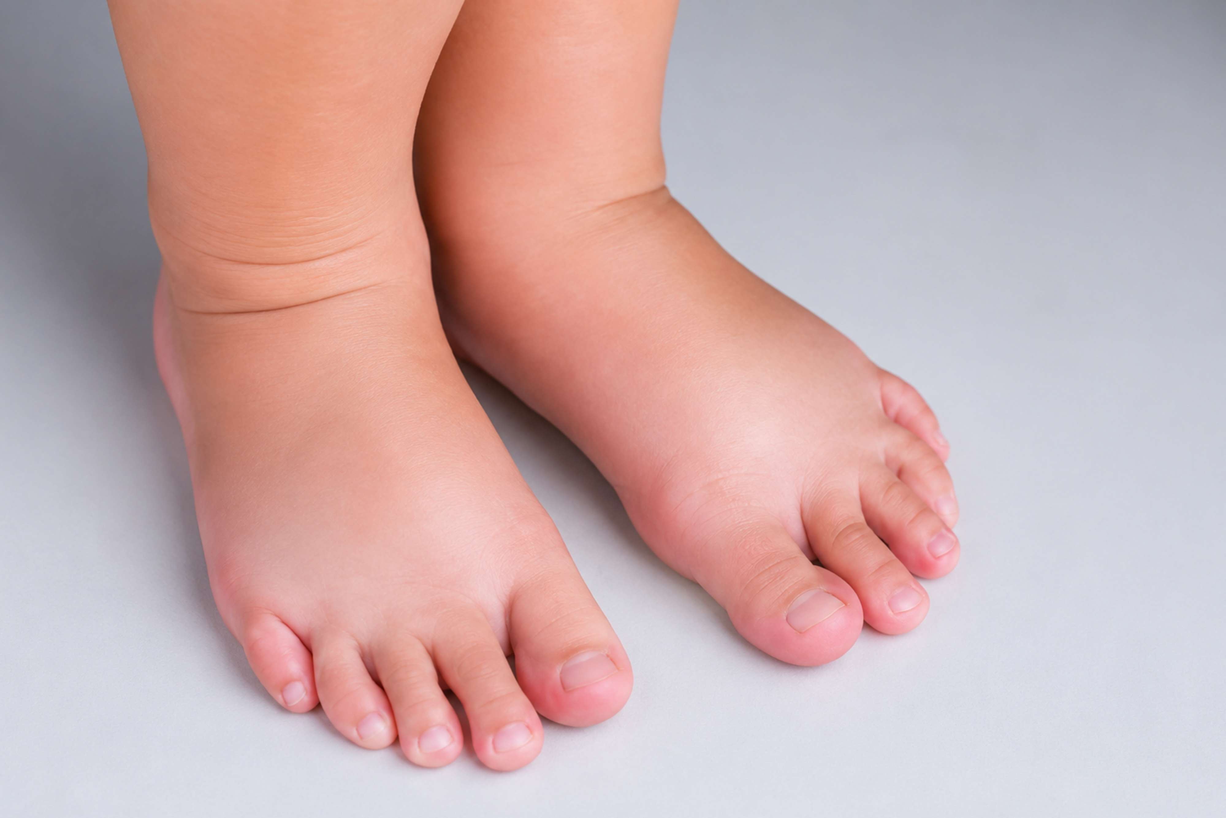 Understanding Lymphoedema, and How LPG Endermologie May Help With Comfort
