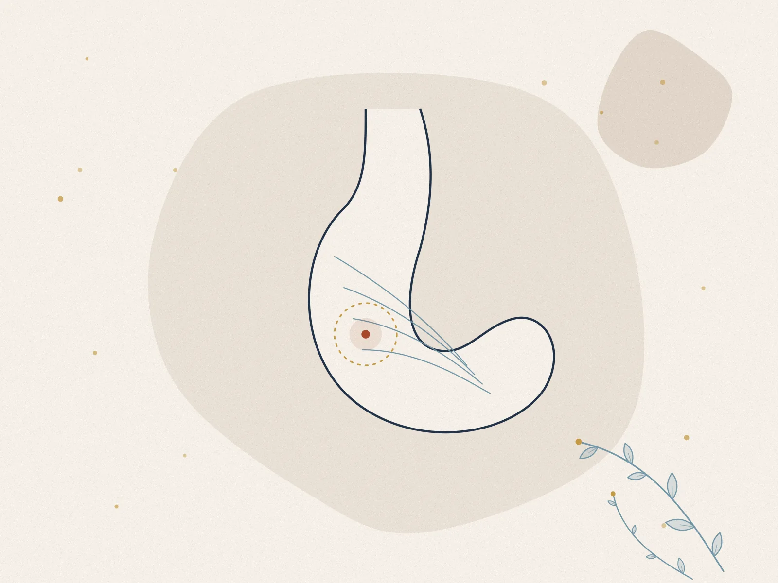 Illustration of stomach ulcer, treated at Omnia Lifestyle clinic in Chiswick, West London