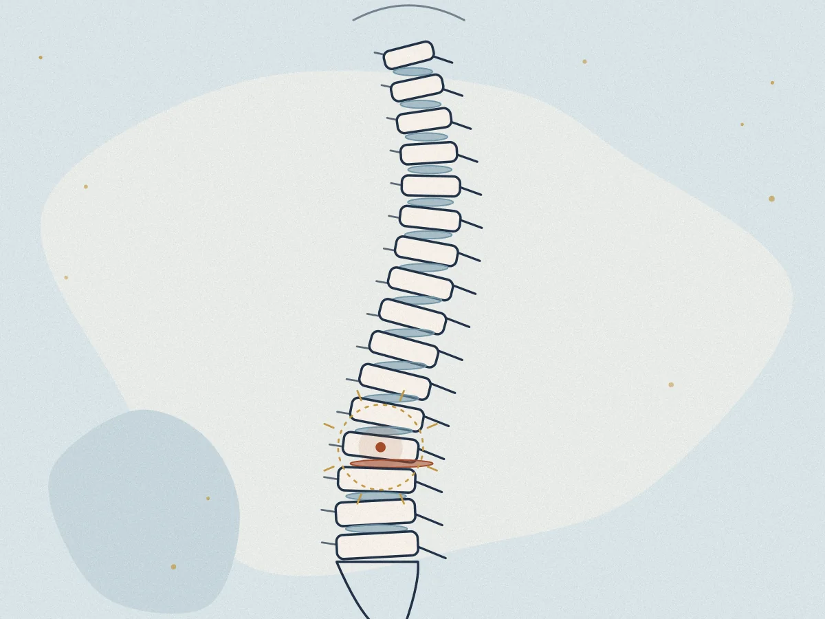 Slipped Disc treatment in Chiswick, London at Omnia Lifestyle