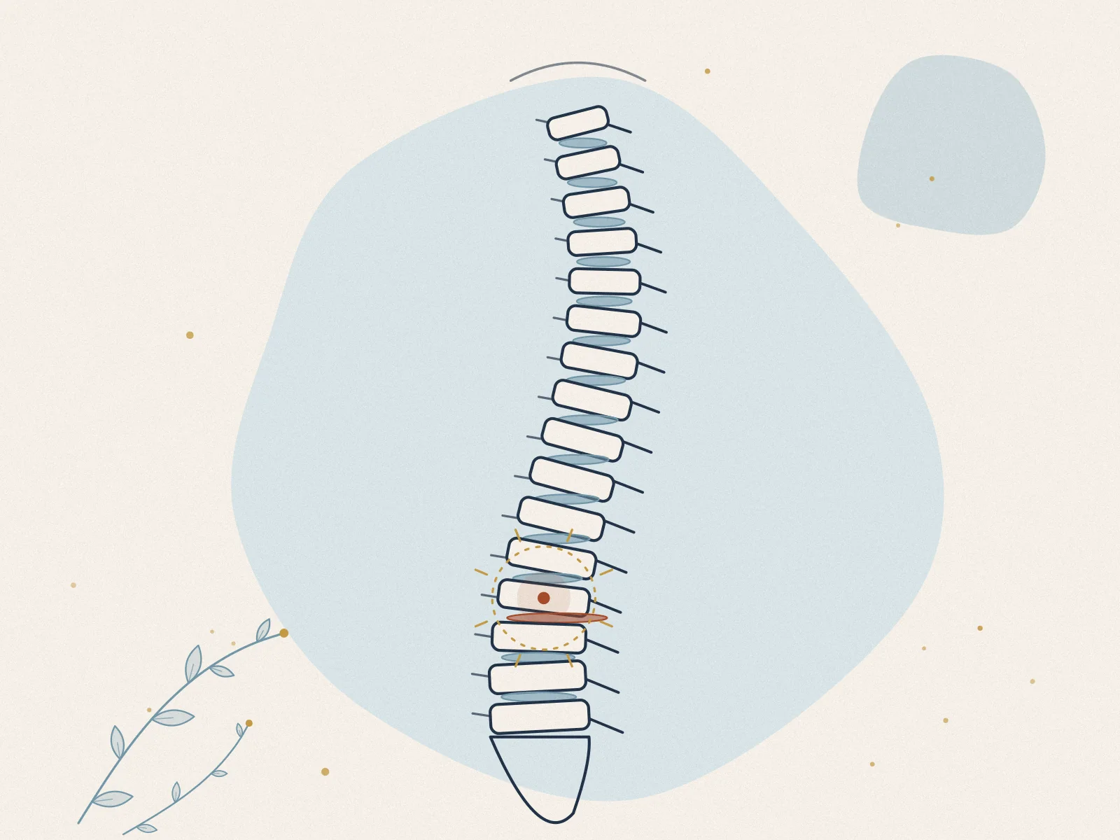 Illustration of slipped disc, treated at Omnia Lifestyle clinic in Chiswick, West London