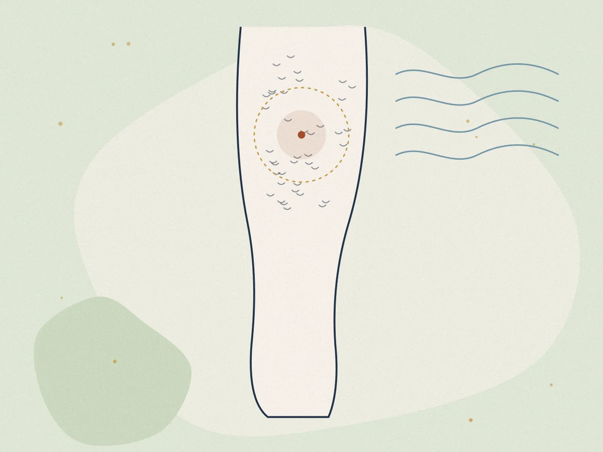 Cellulite Reduction treatment in Chiswick, London at Omnia Lifestyle