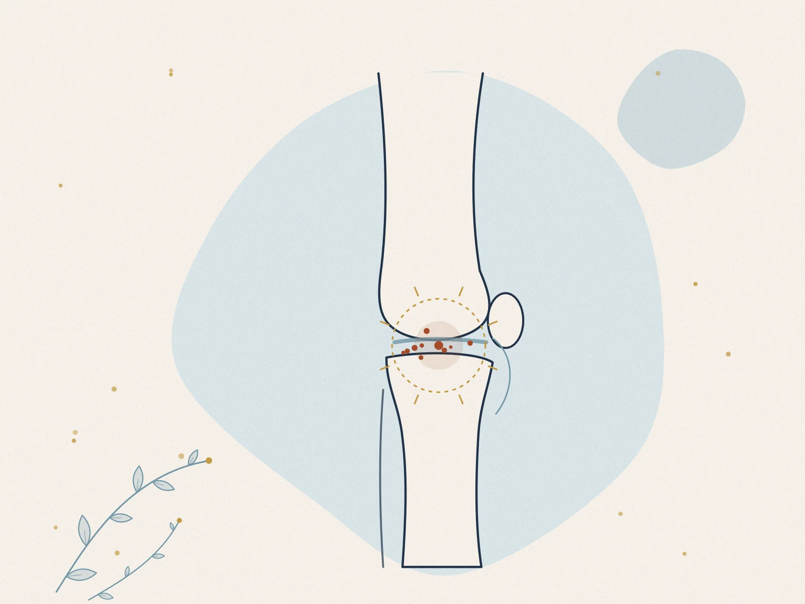 Illustration of arthritis, treated at Omnia Lifestyle clinic in Chiswick, West London