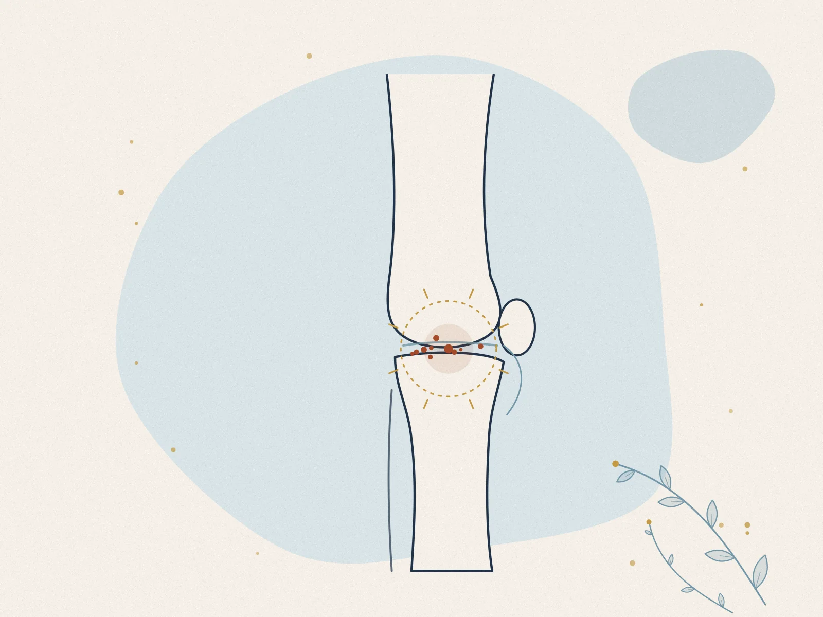Illustration of osteoarthritis, treated at Omnia Lifestyle clinic in Chiswick, West London