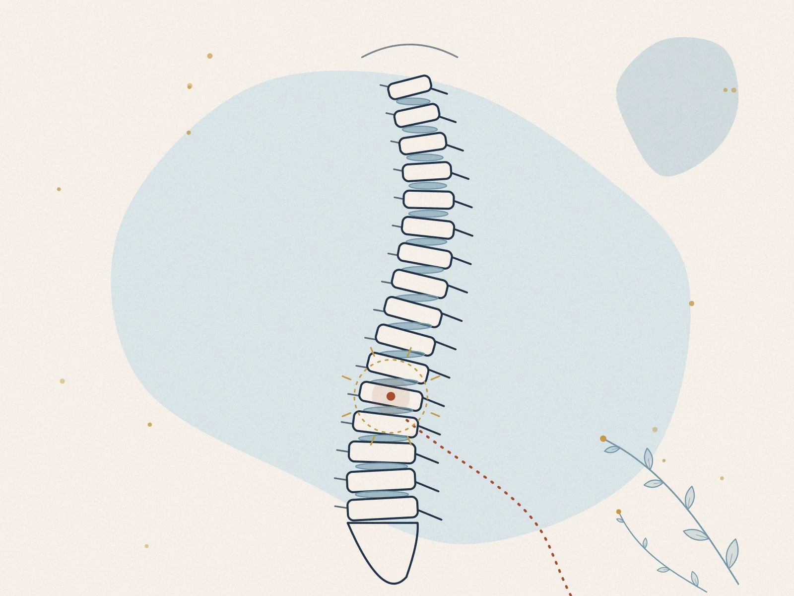 Illustration of sciatica, treated at Omnia Lifestyle clinic in Chiswick, West London