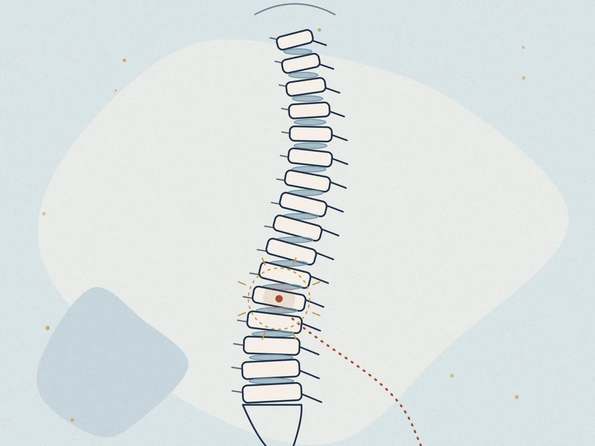 Sciatica treatment at Omnia Lifestyle, Chiswick, illustrated