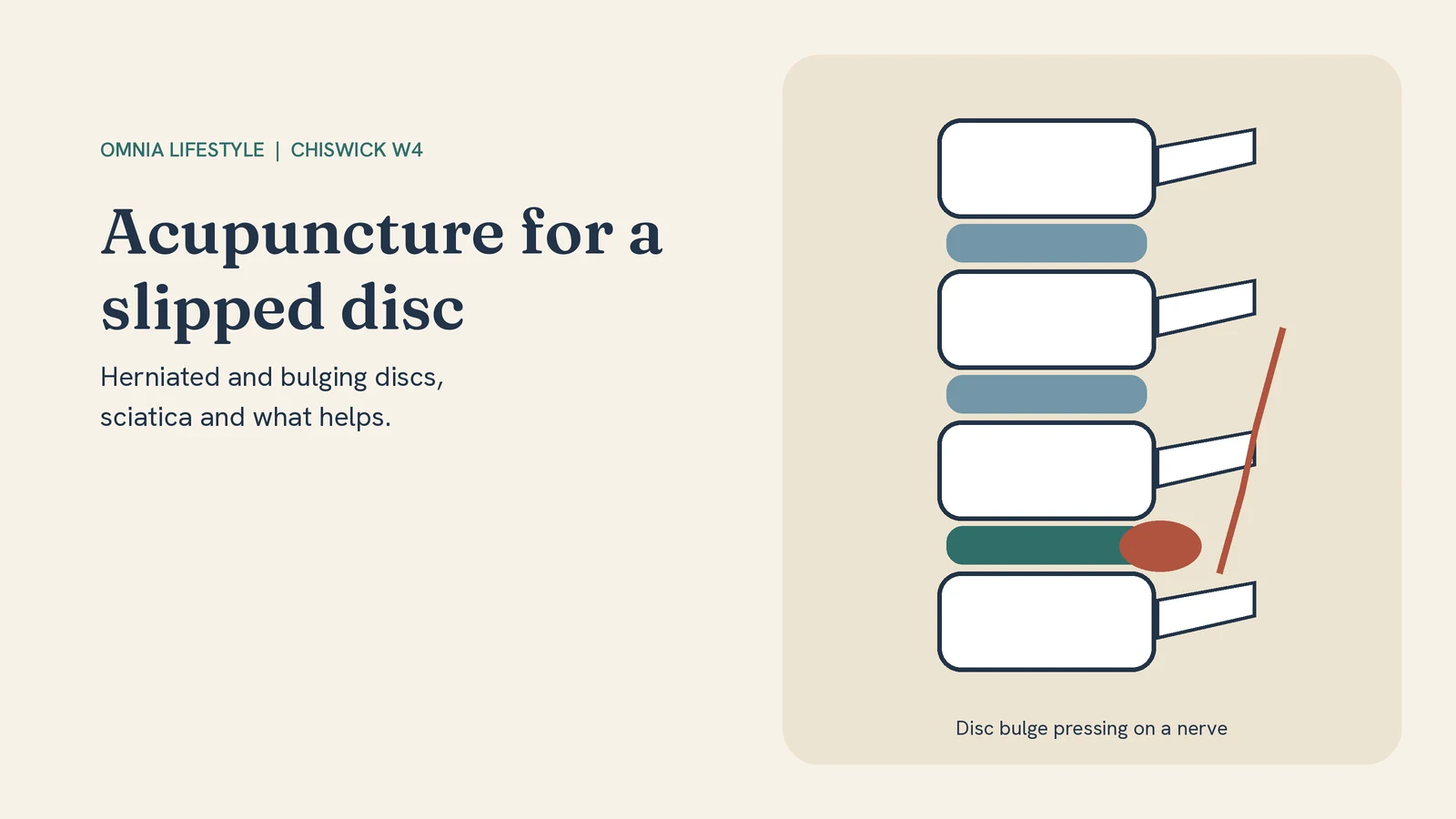 Acupuncture for a Slipped Disc and Sciatica