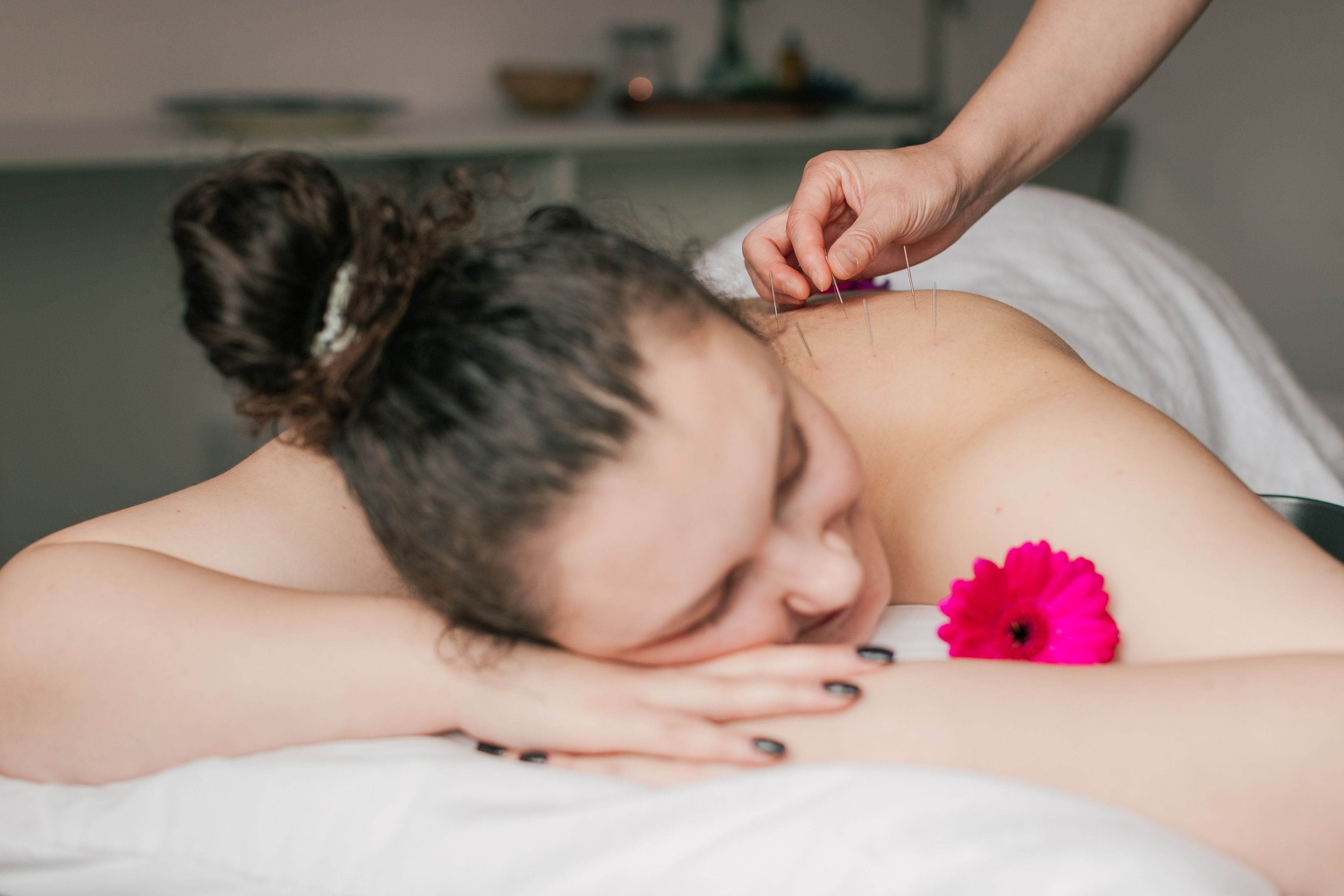 Acupuncture