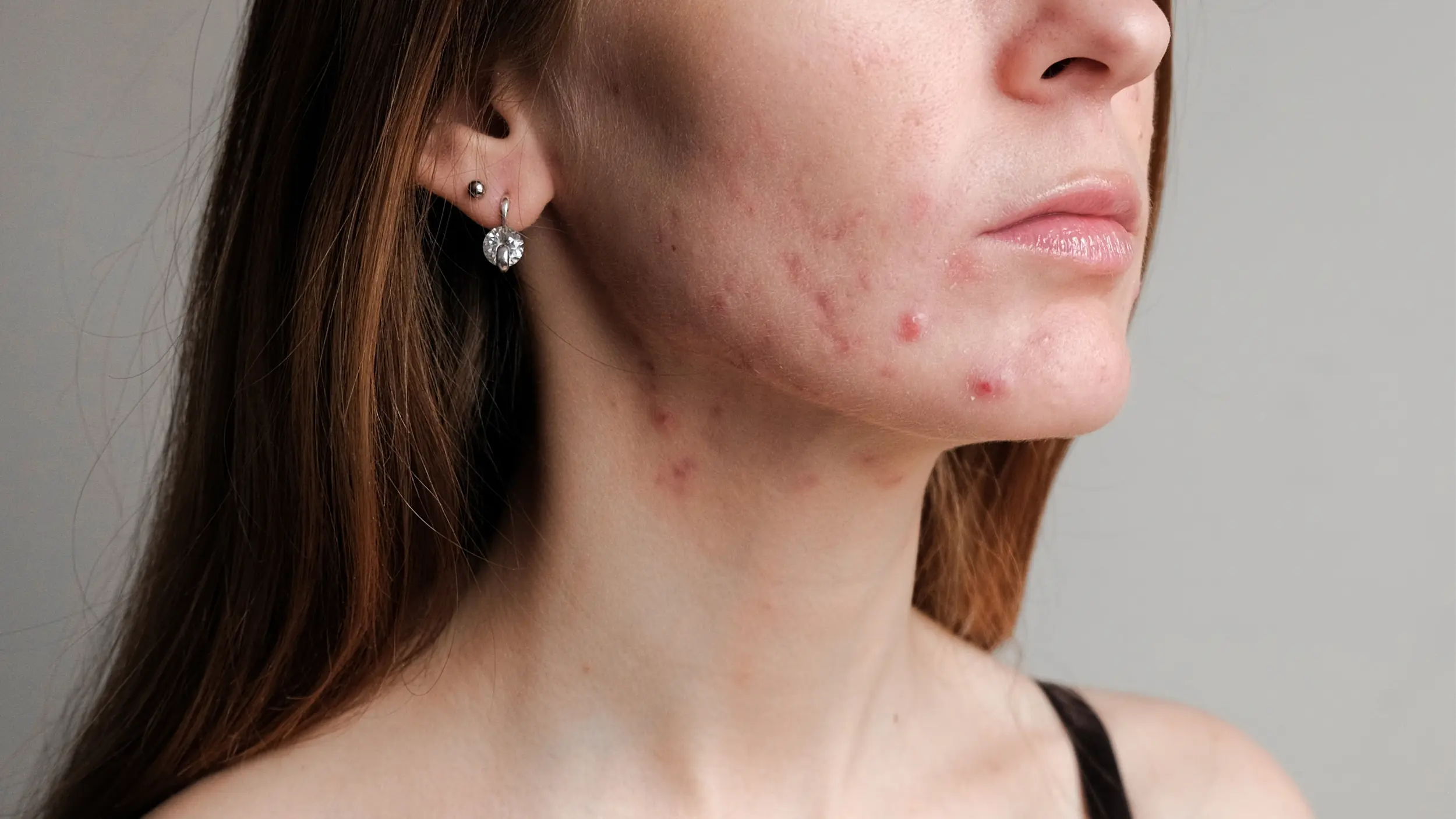 woman with acne