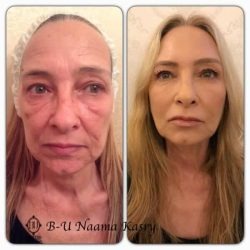 חומצה היאלורונית הזרקות לפנים לפני ואחרי