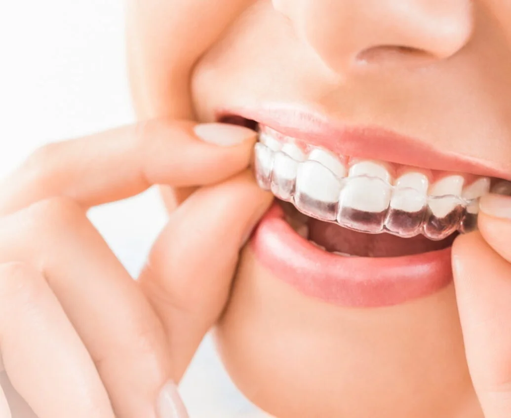 Person inserting a clear dental aligner over their upper teeth with fingers.