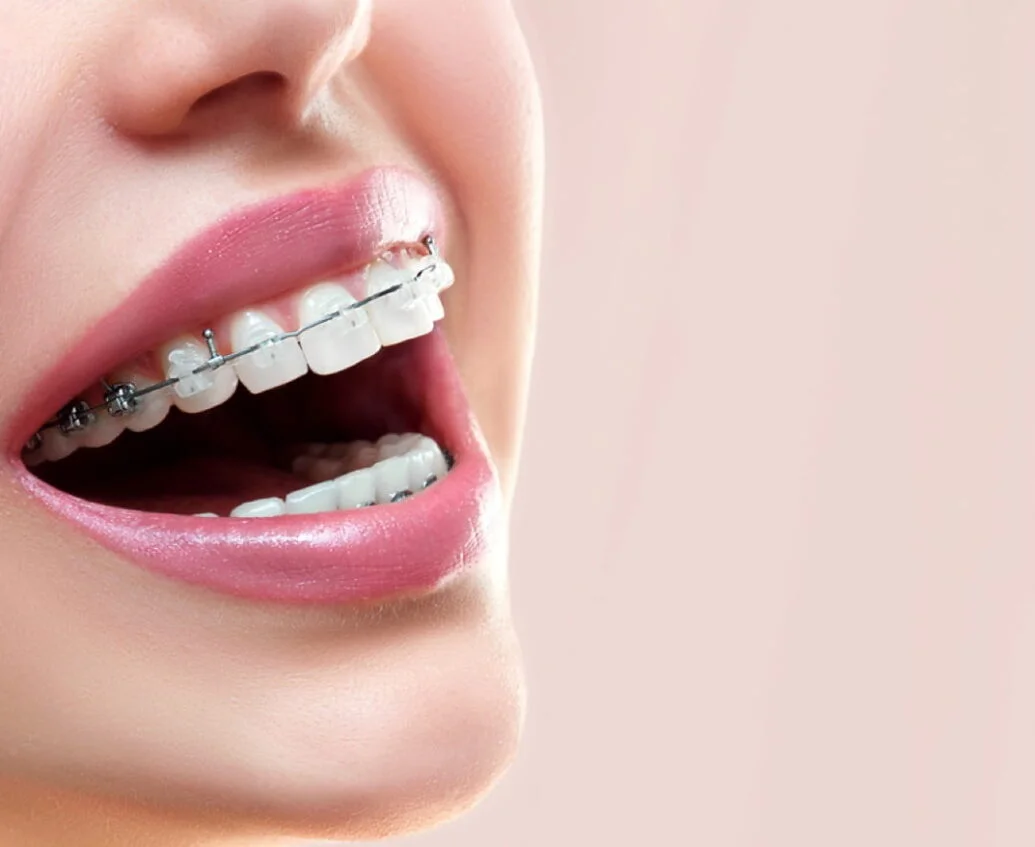 Close-up of a smiling mouth with ceramic braces on upper teeth and metal braces on lower teeth.