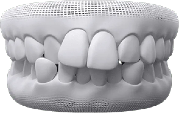 3D render of a dental model showing misaligned and crooked teeth from the front view.