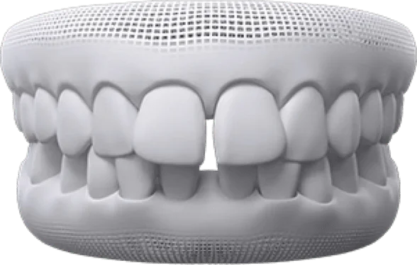 3D model of upper and lower teeth with irregular spacing and gaps.