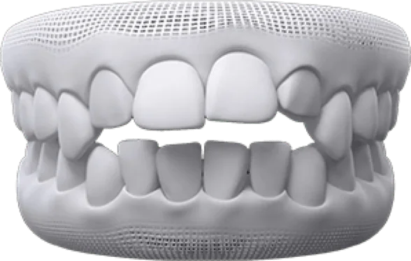 3D render of a mouth with teeth gaps and irregular tooth shapes in upper and lower jaws.