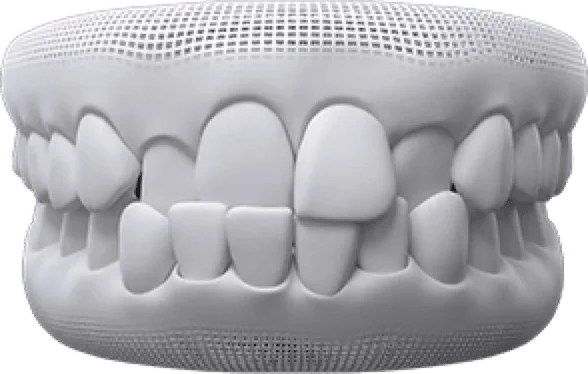 3D rendering of a mouth dental model showing misaligned teeth and crowding.