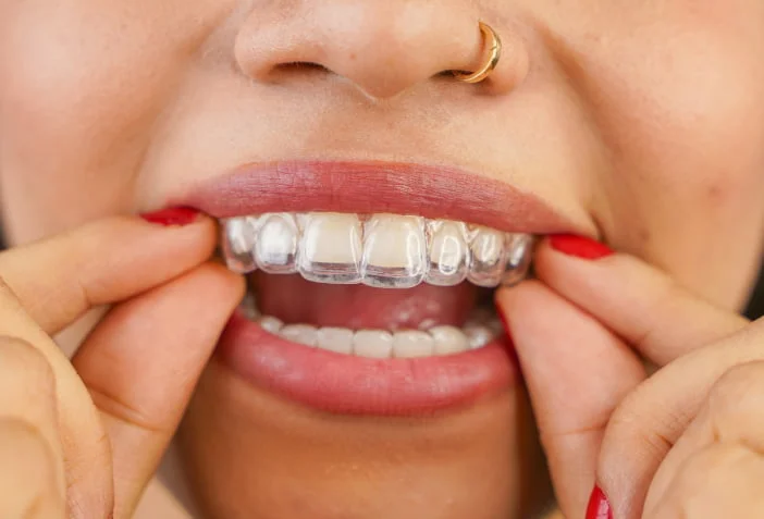 Person with red nail polish and nose ring inserting a clear dental aligner on upper teeth.