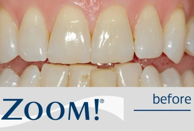 Close-up of teeth showing discoloration and wear before Zoom! whitening treatment.