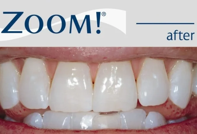 Close-up of a person's teeth after Zoom whitening treatment showing bright, clean teeth.