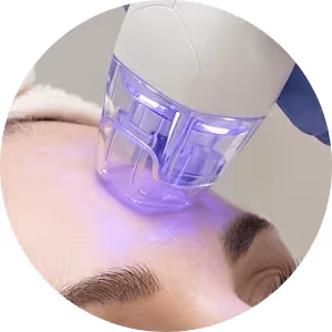 Radiofrequenz Microneedling Behandlung in Wien