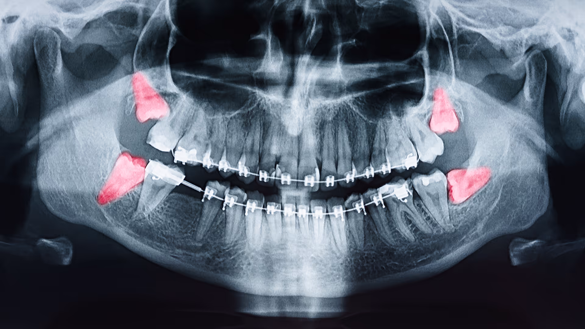 Wisdom teeth removal procedure at Organ Mountain Dental in Las Cruces, NM