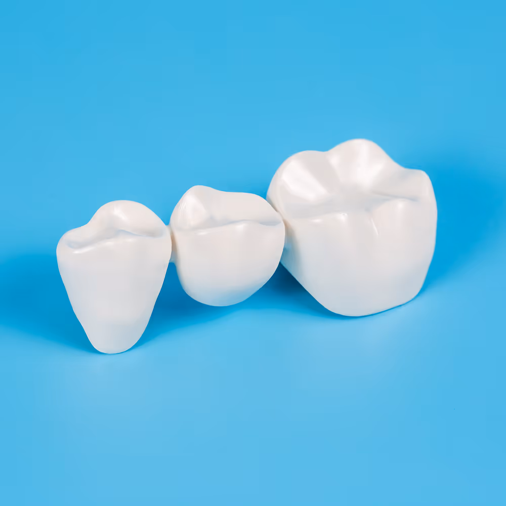 Diagram of a dental bridge with pontic and crowns anchored to adjacent natural teeth