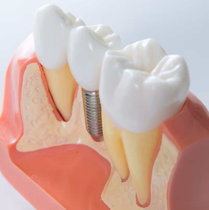 What Are Same Day Dental Implants?