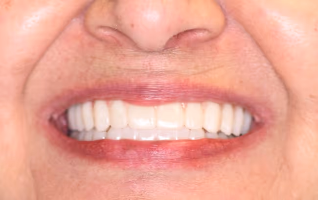 Beautiful smile results after full mouth dental implant restoration with All-on-X
