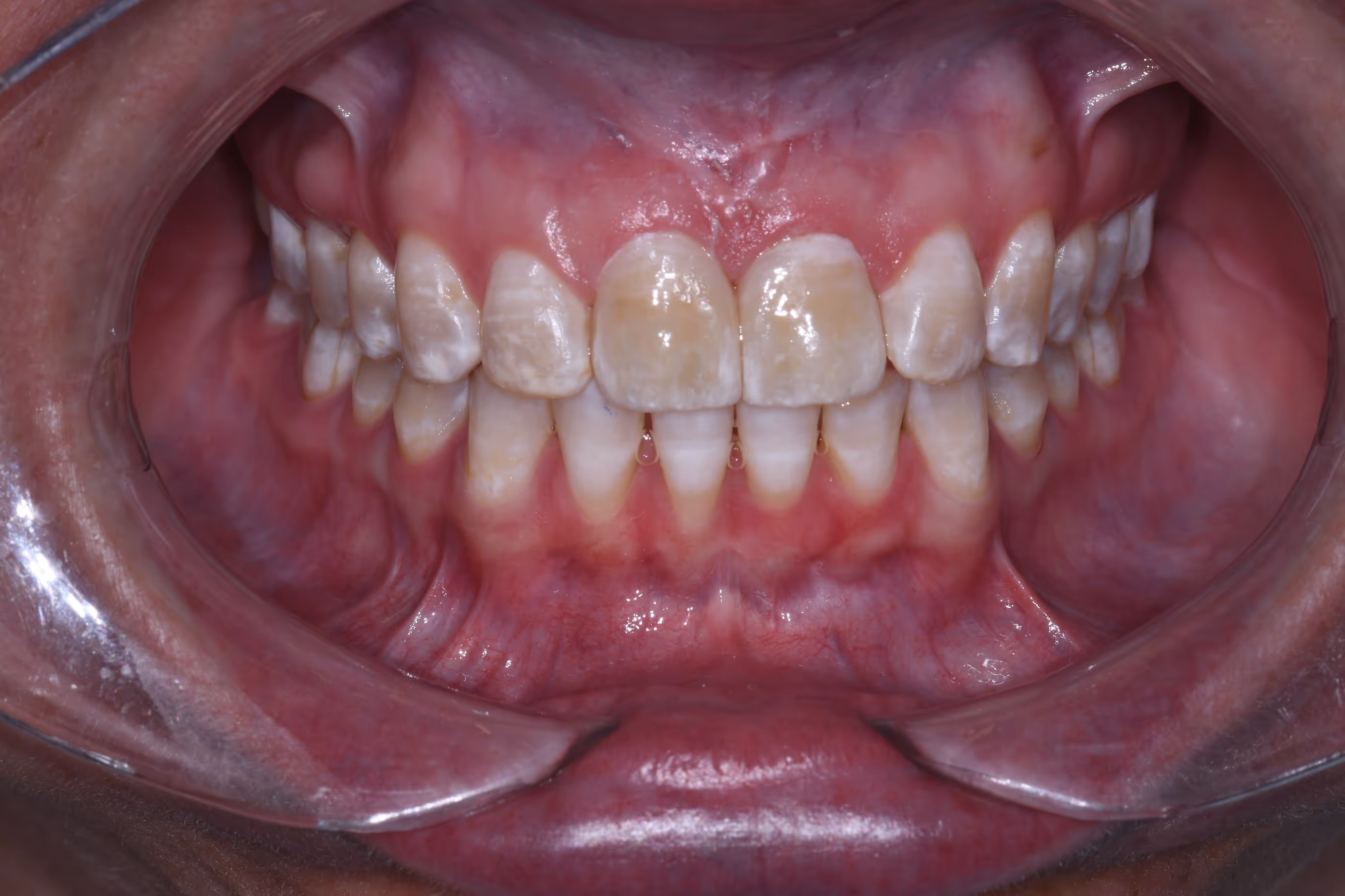 Smile after porcelain crowns on front teeth #8 and #9 at Organ Mountain Dental