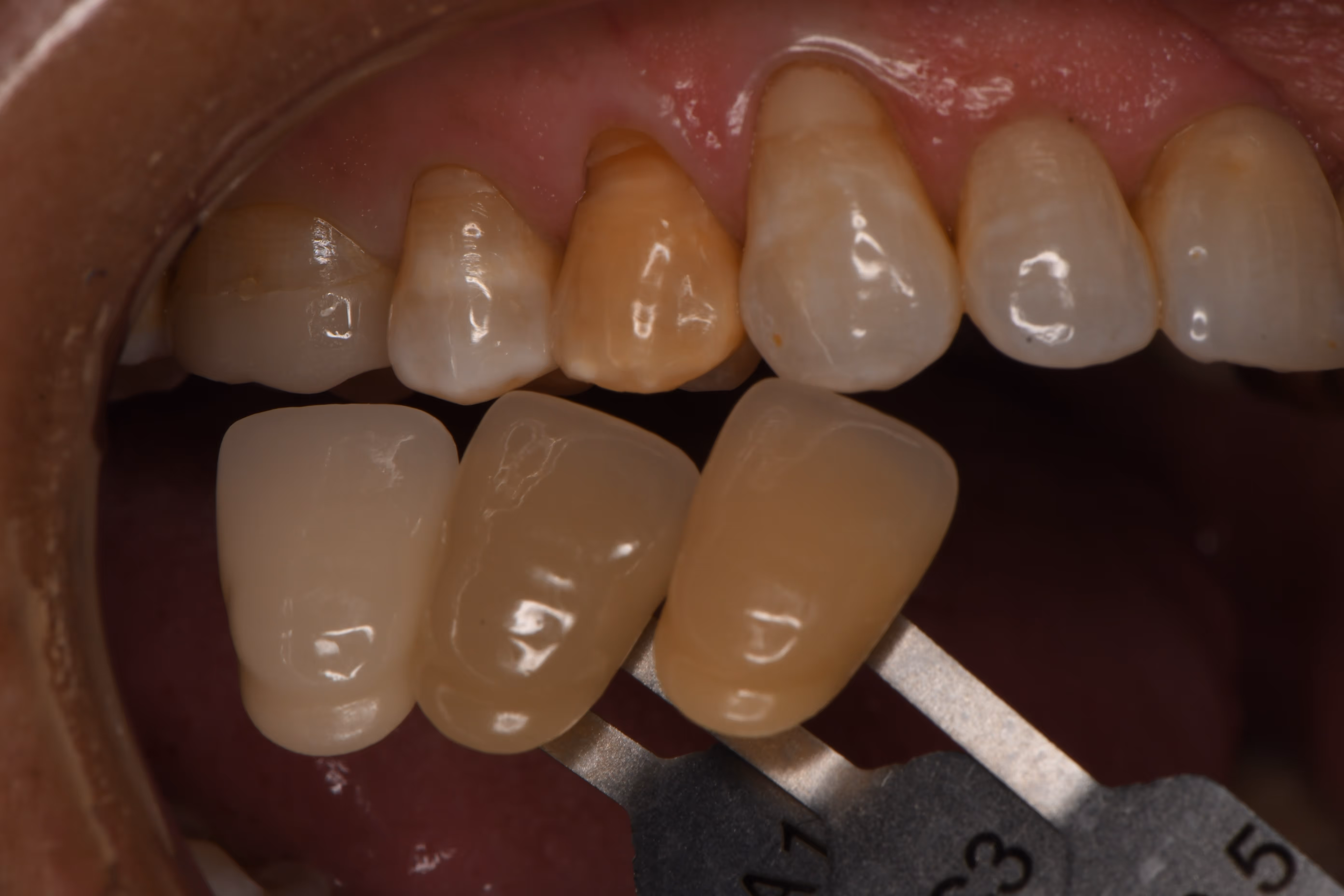 Veneer shade matching process for natural-looking results at Organ Mountain Dental