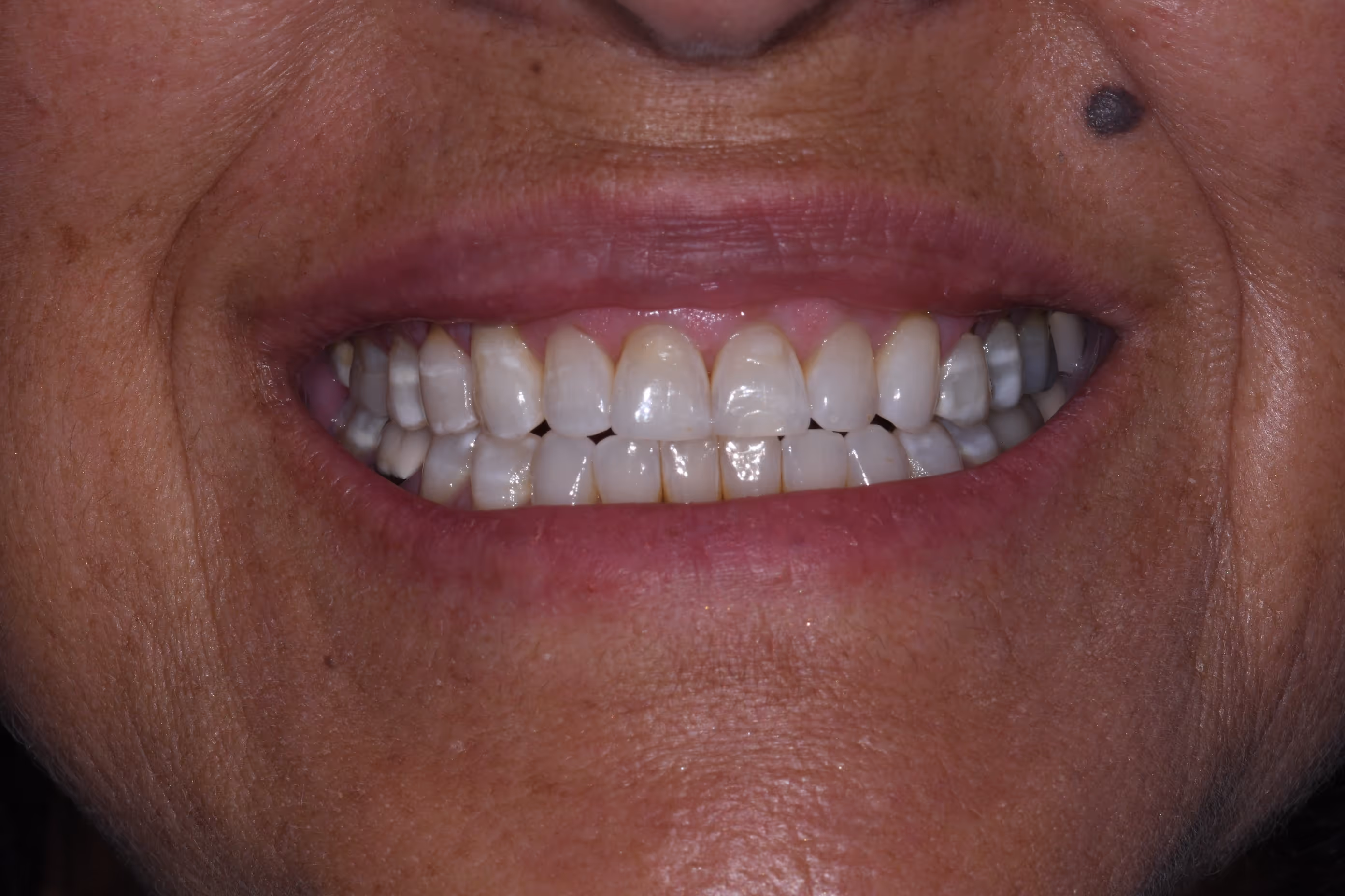 Full smile transformation with porcelain veneers in Las Cruces, NM