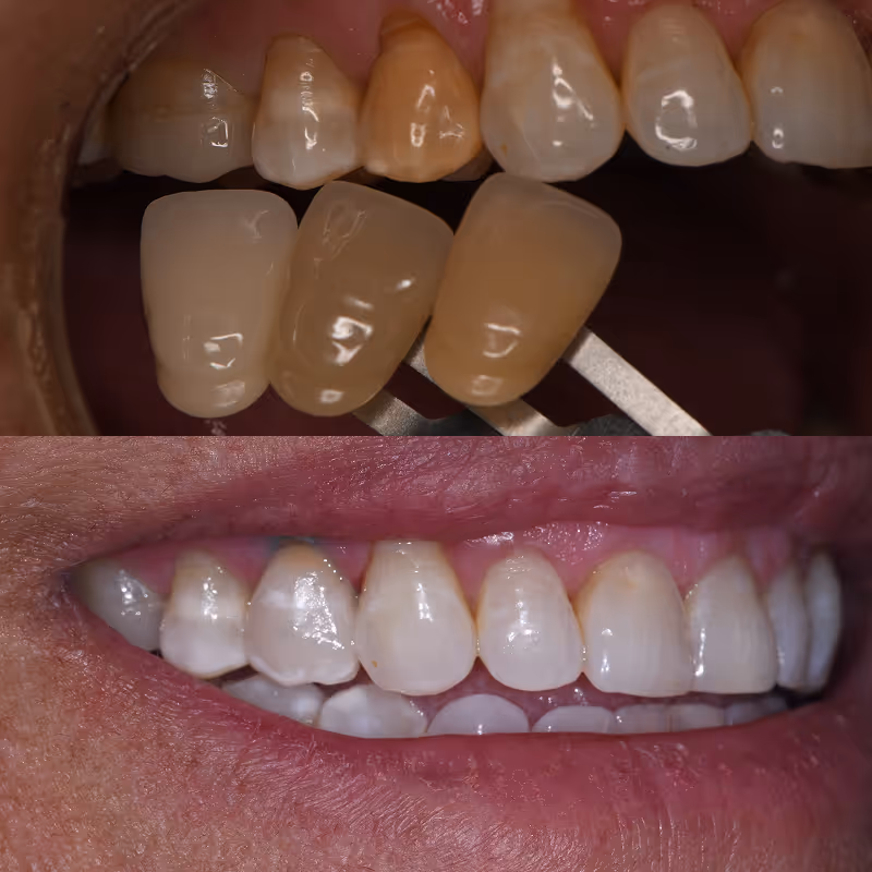 Before & after Porcelain Veneers at Organ Mountain Dental