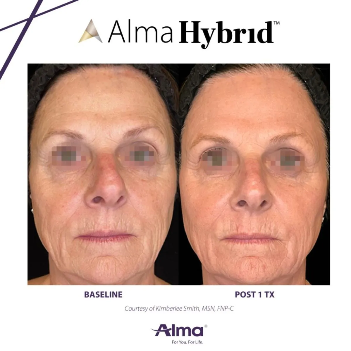 Side-by-side comparison of a woman's face at baseline and after one Alma Hybrid treatment showing reduced redness and improved skin texture.