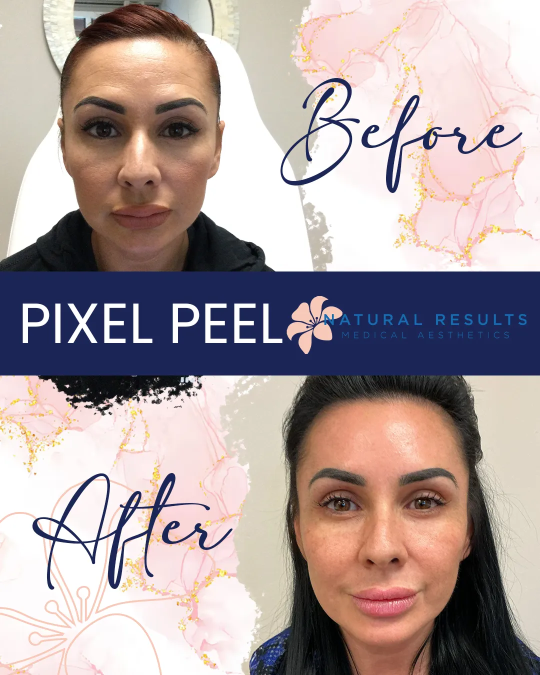 Before and after photos showing results of a Pixel Peel facial treatment on a woman.