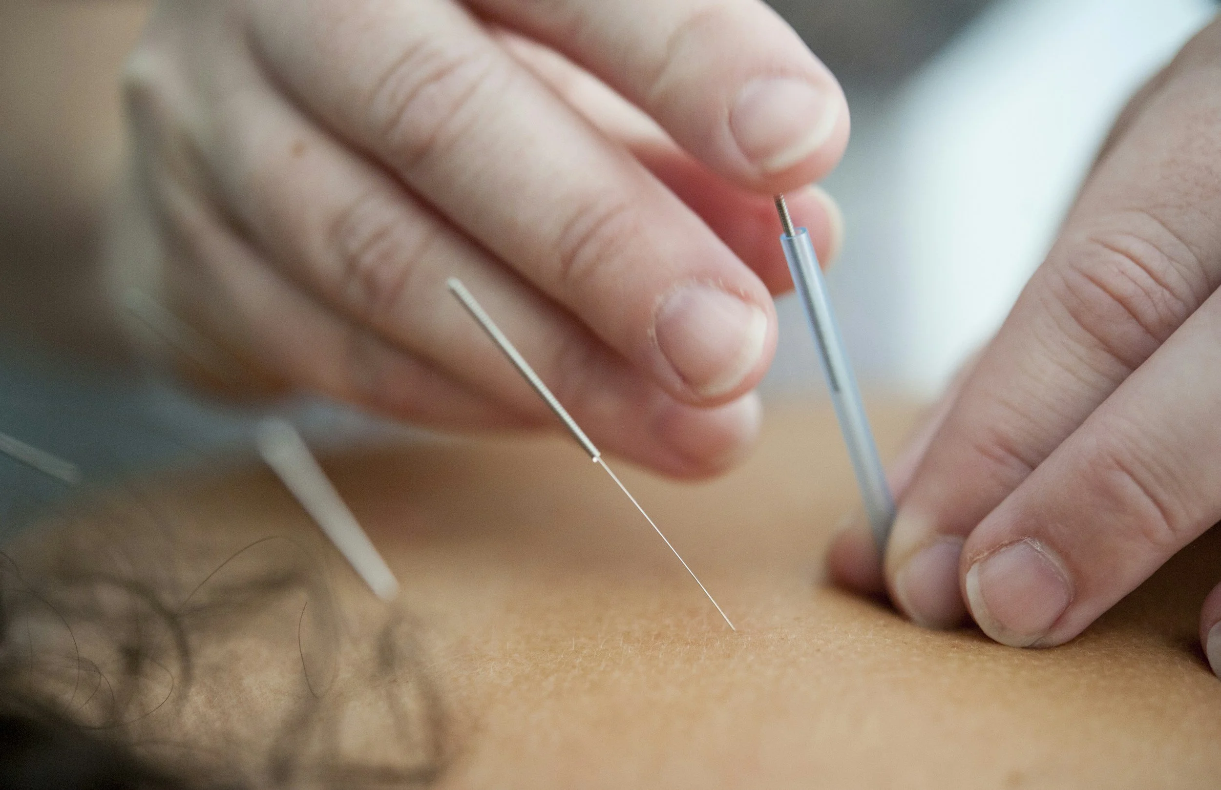 dry needling