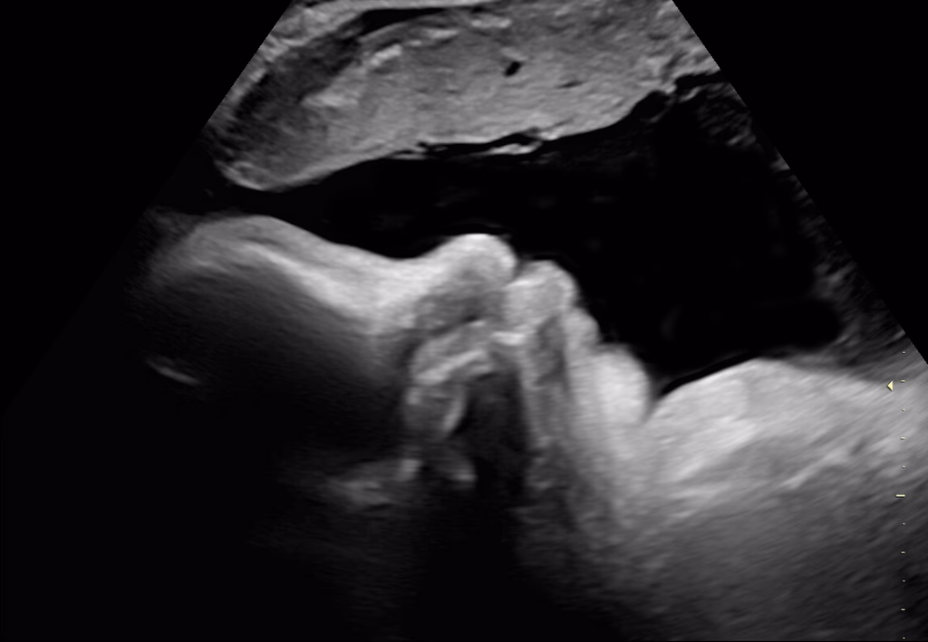 Ultraljudsbild som visar en fosterprofil med huvud, näsa och mun synliga.