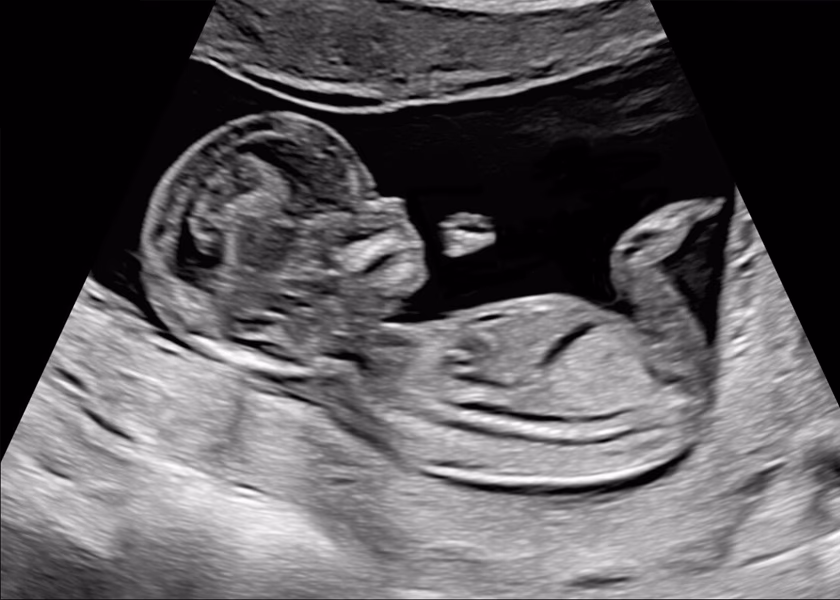 Ultraljudsbild av en fosterprofil i livmodern.