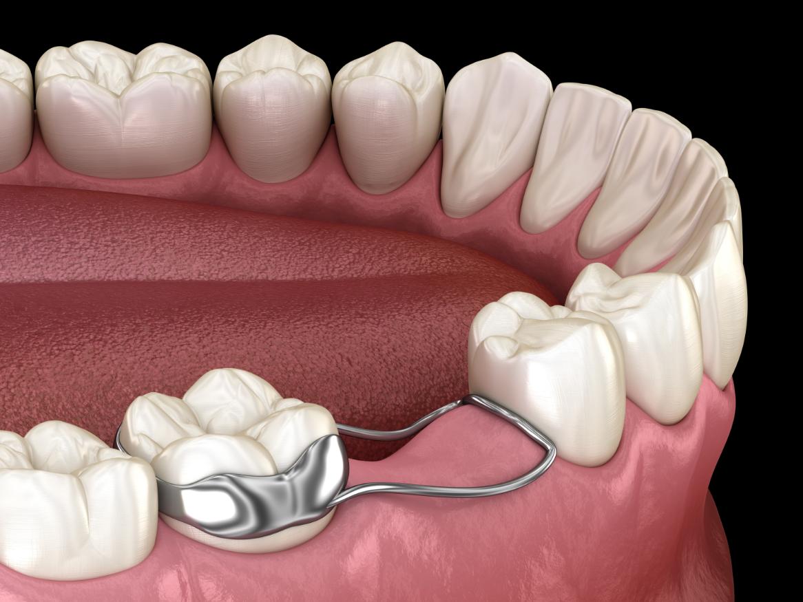 3D model of a lower arch with a metal space maintainer appliance