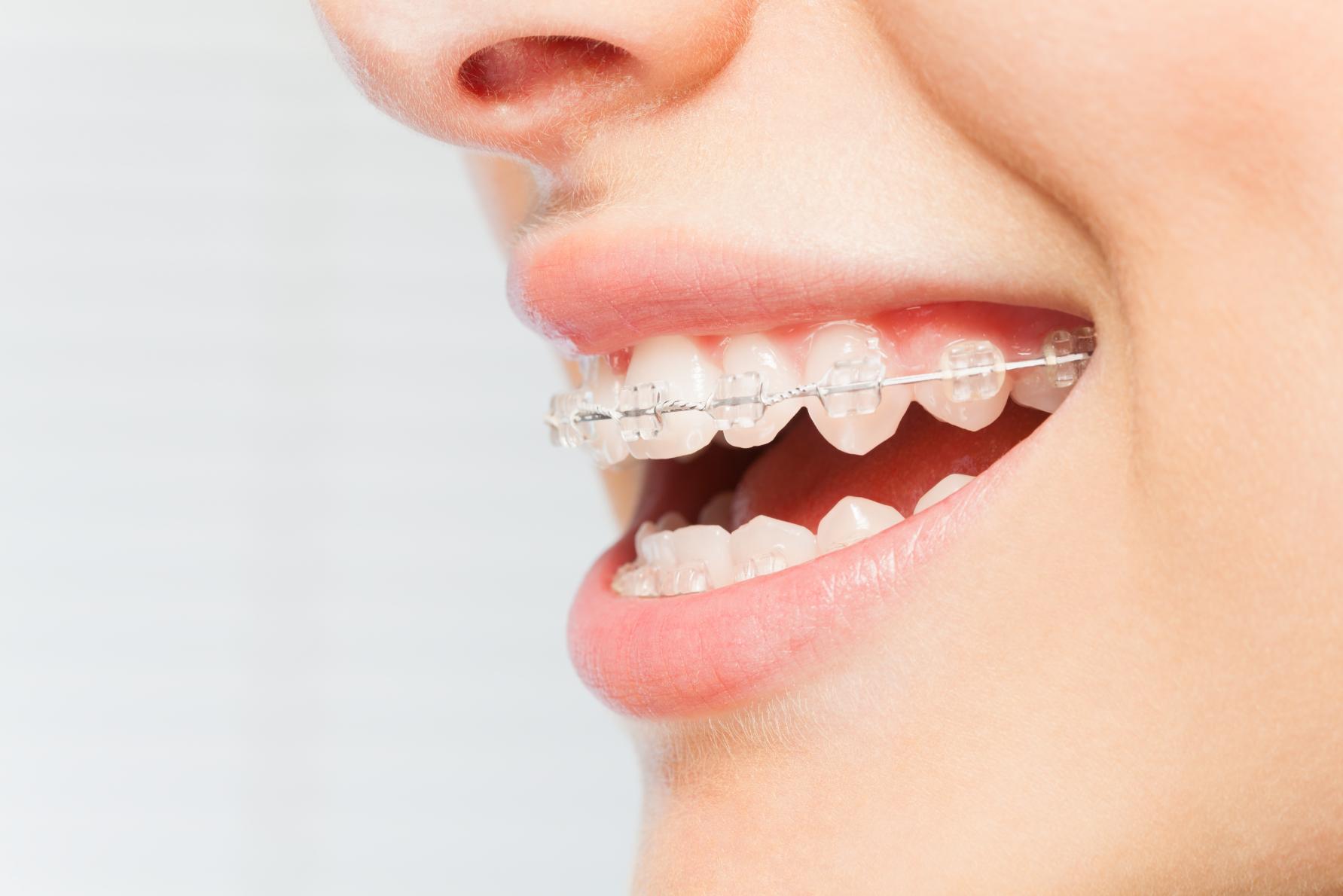 Close-up of ceramic braces from Friendly Neighborhood Orthodontist in La Grange, IL