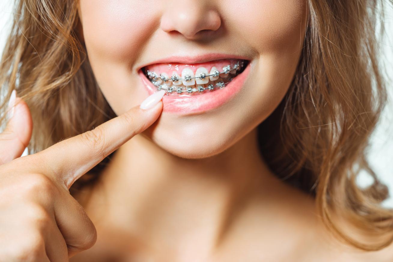 Close-up of a woman pointing to her upper teeth with metal braces