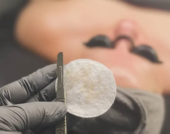 Close-up of a gloved hand holding a scalpel and a cotton pad in front of a man's chest with a mustache, suggesting a medical or cosmetic procedure.
